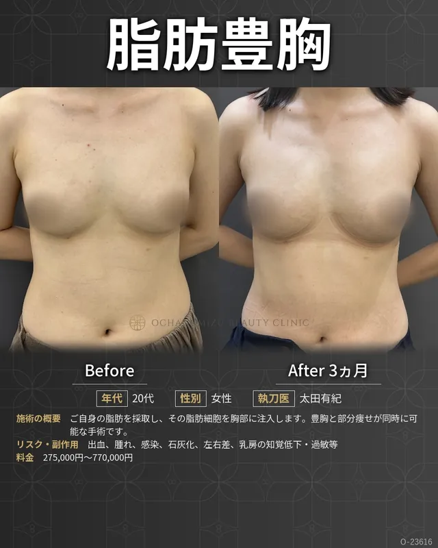 脂肪豊胸