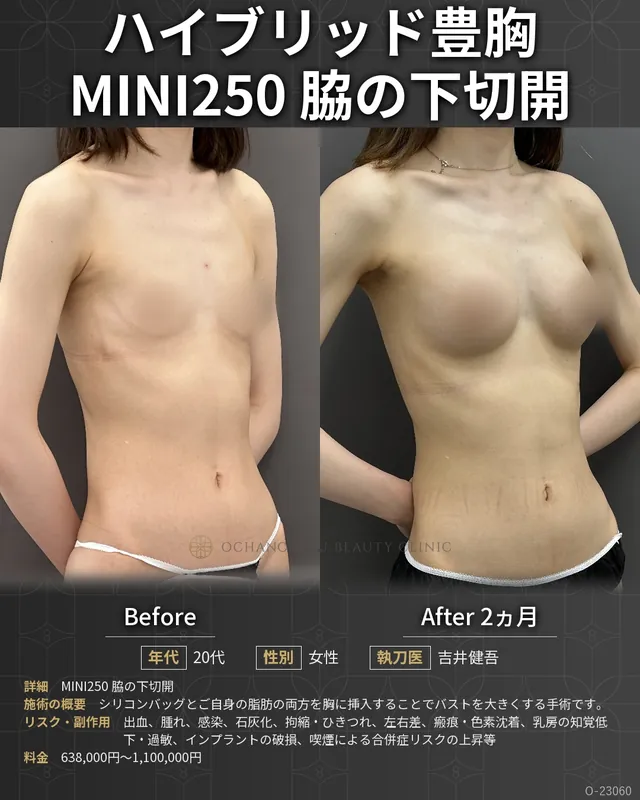 ハイブリッド豊胸