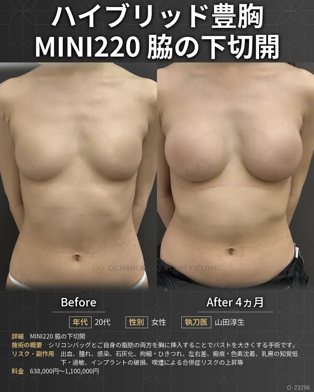 ハイブリッド豊胸