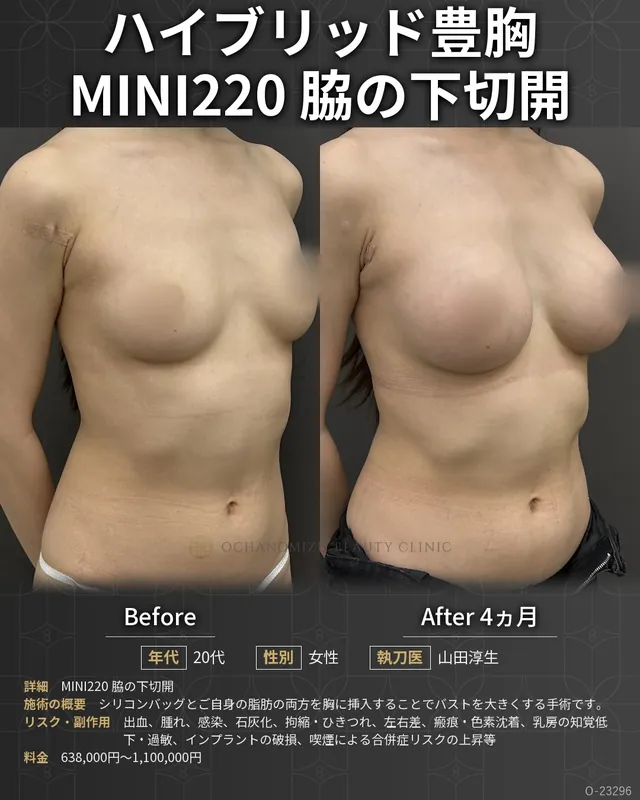 ハイブリッド豊胸