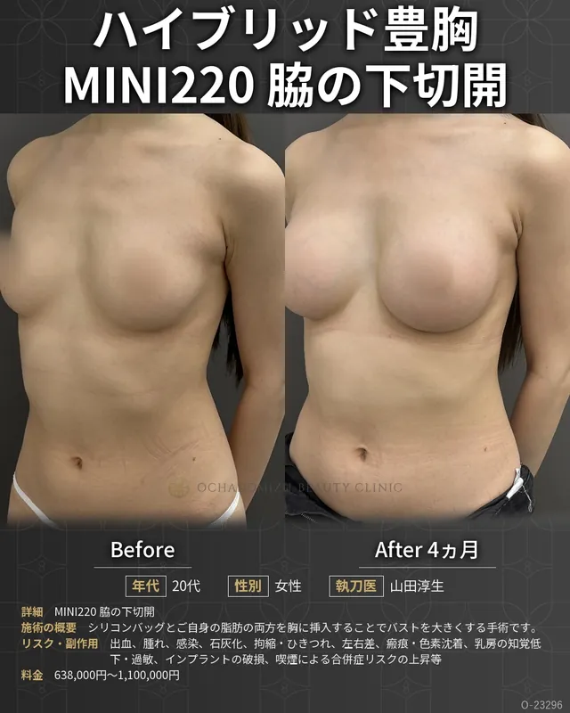 ハイブリッド豊胸