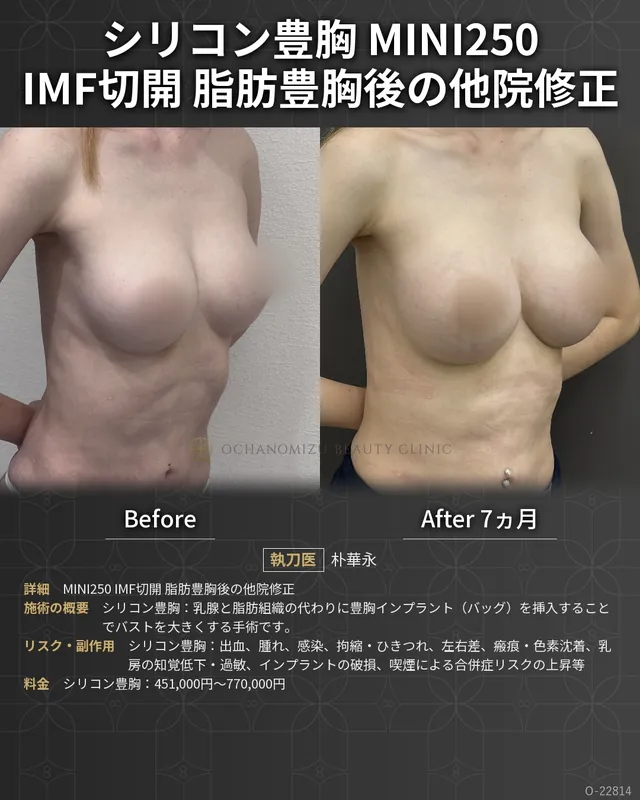 シリコン豊胸＋他院修正