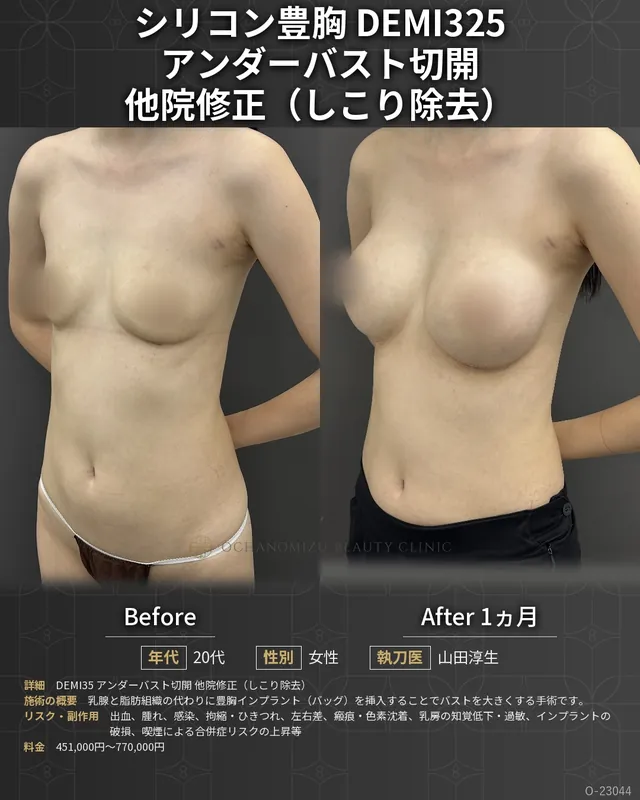 シリコン豊胸＋他院修正＋異物除去