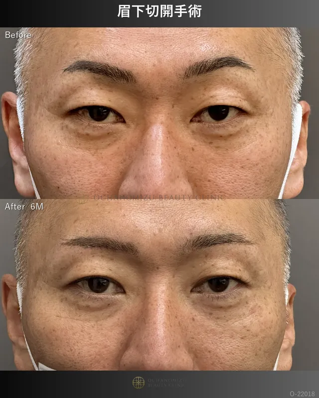 眉下切開