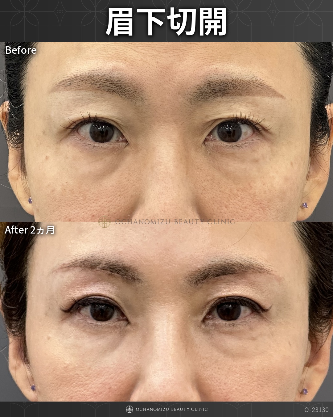 眉下切開