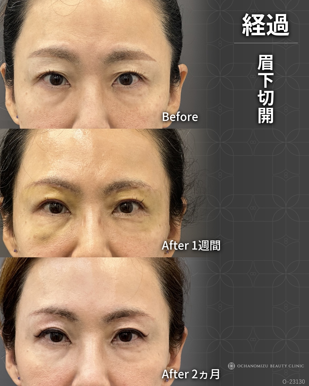 眉下切開