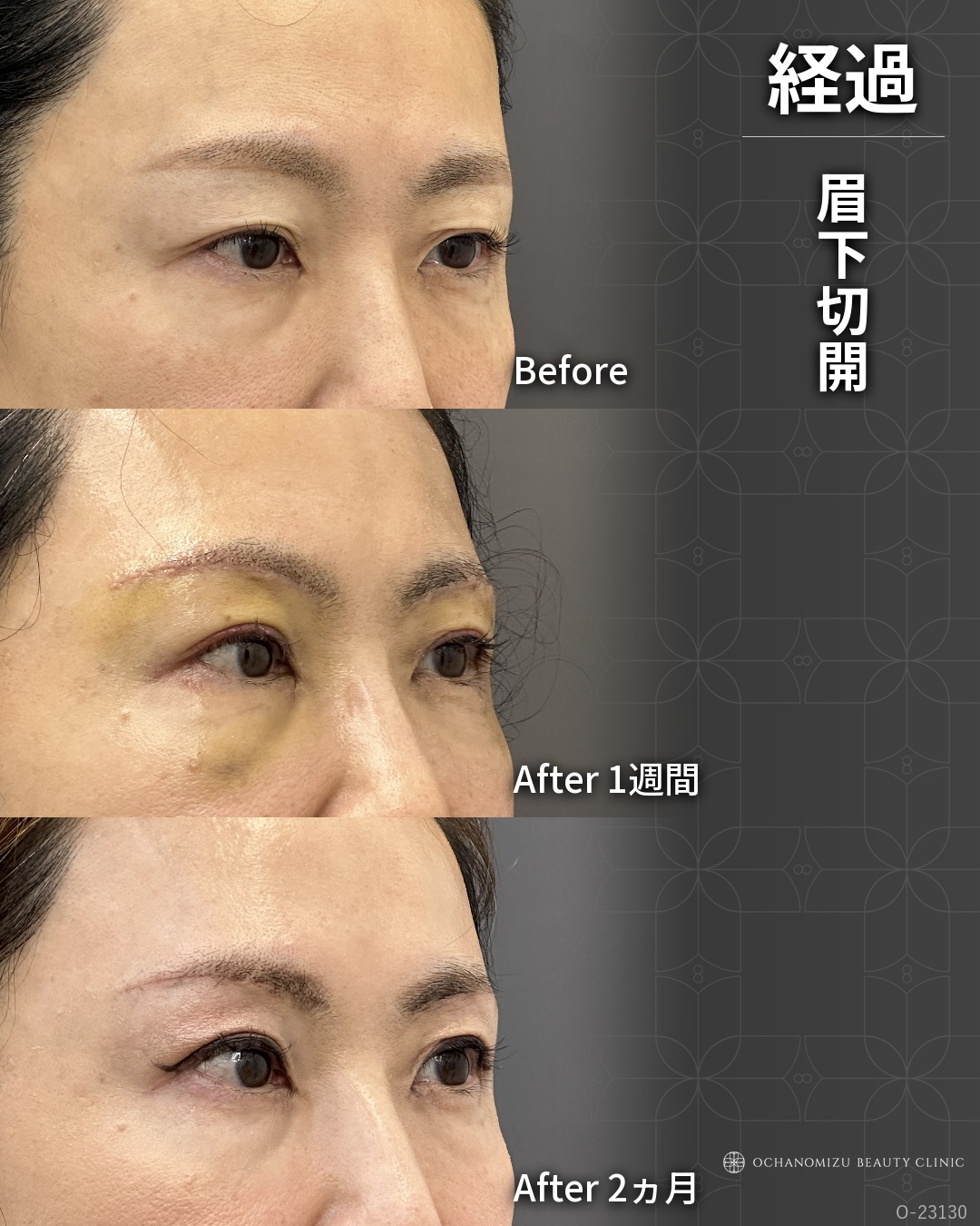眉下切開