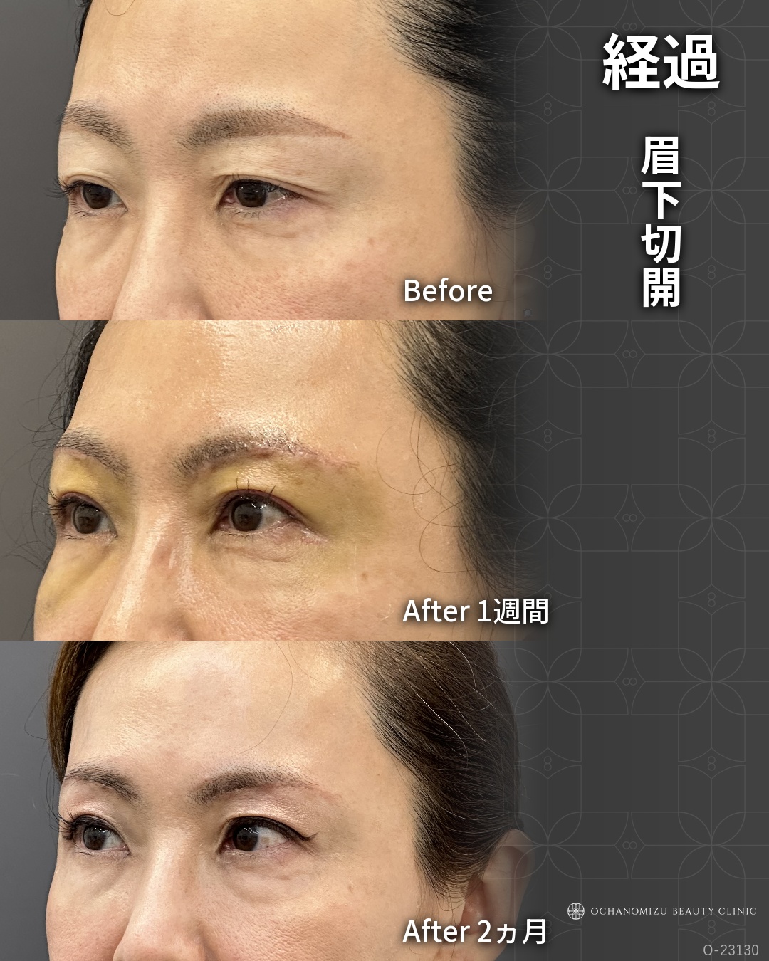 眉下切開