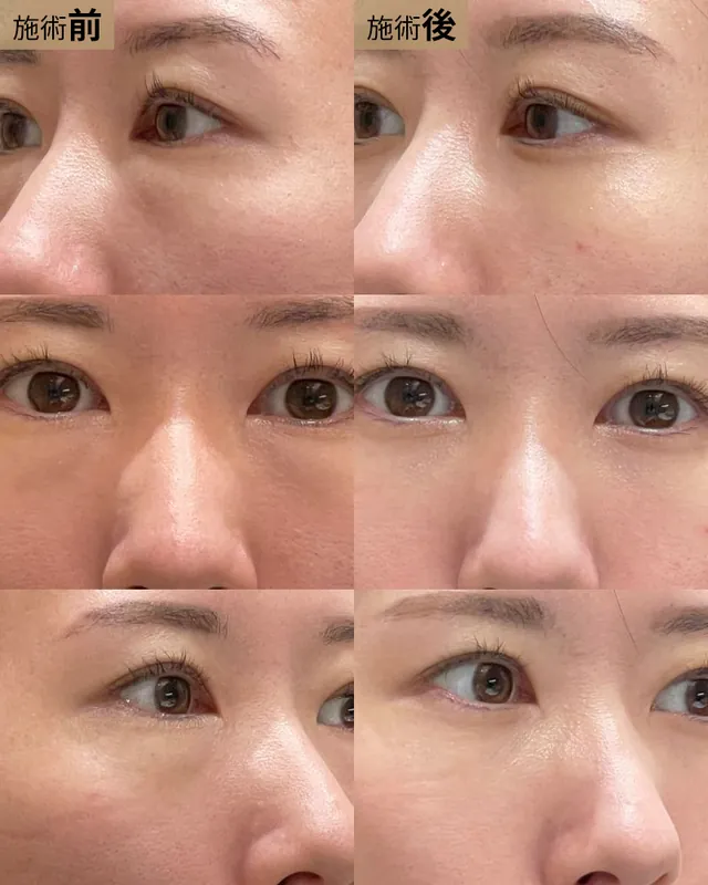 経結膜脱脂