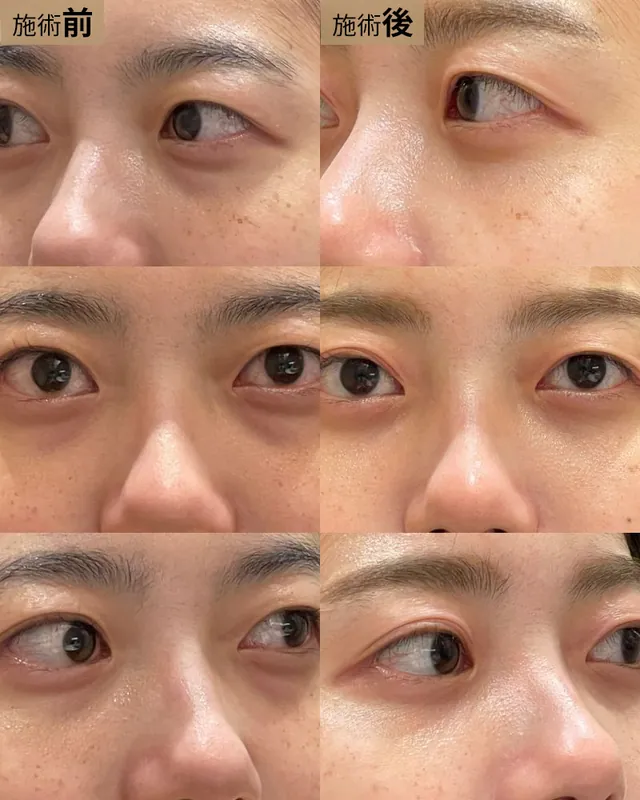 経結膜脱脂