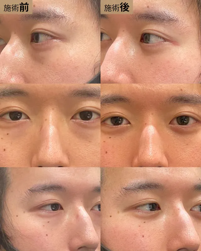 経結膜脱脂