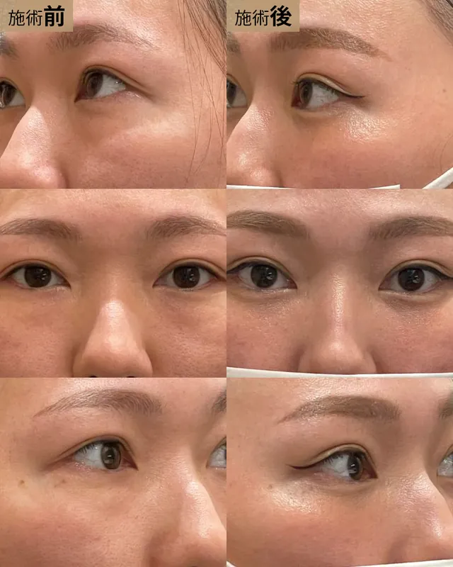 経結膜脱脂