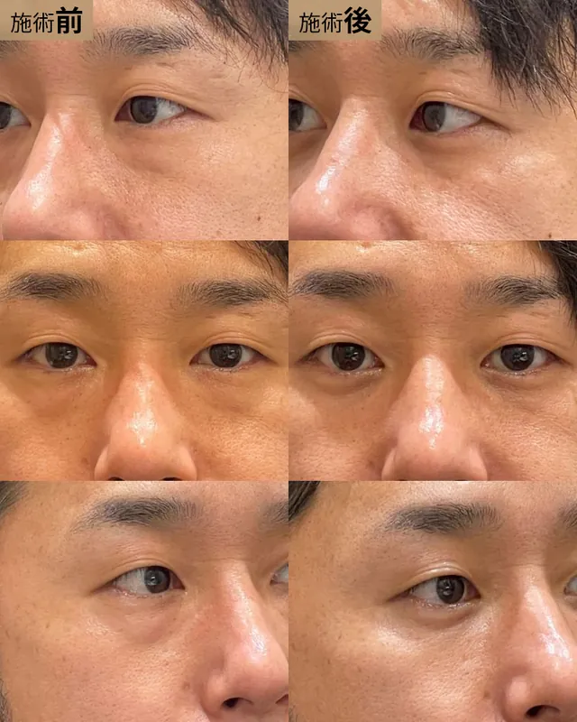 経結膜脱脂