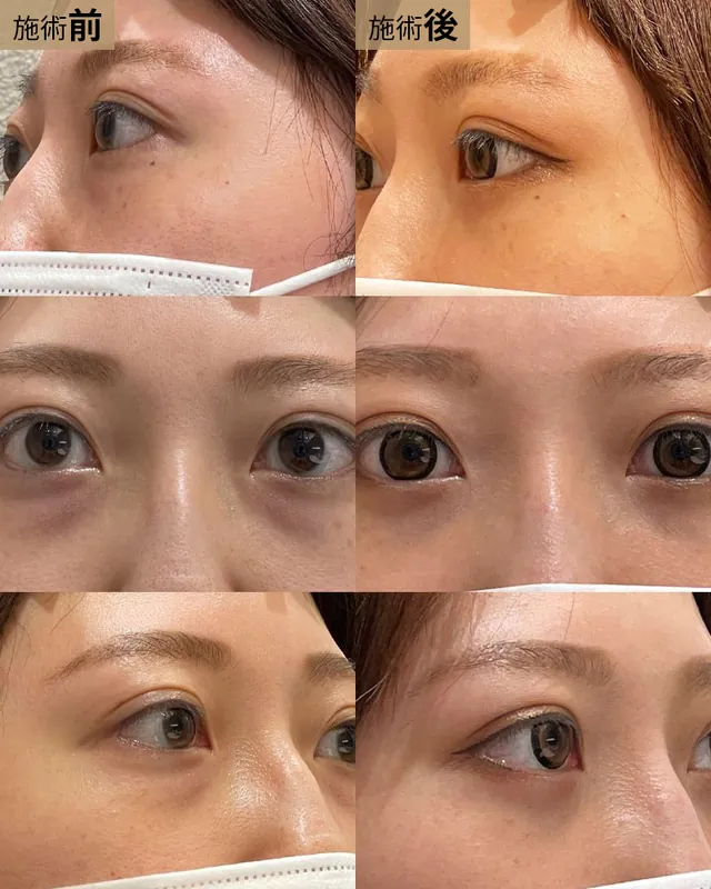 経結膜脱脂