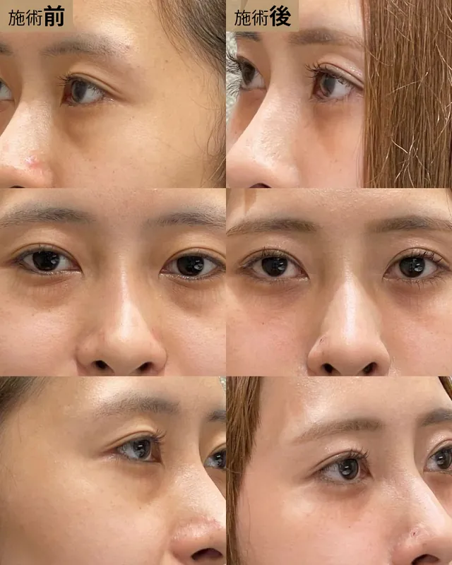 経結膜脱脂