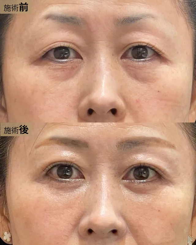 クマ取り＆脂肪注入