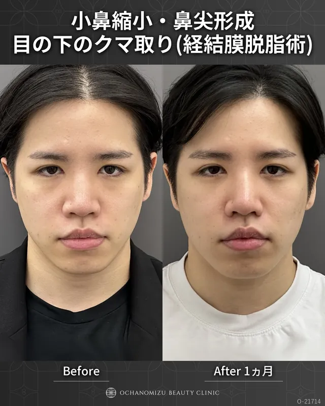 小鼻縮小＋鼻尖形成＋目の下のクマ取り(経結膜脱脂術)