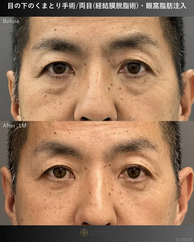 目の下のクマ取り(経結膜脱脂術)＋眼窩脂肪注入