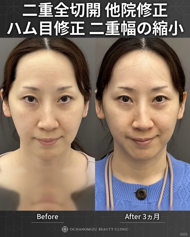 二重全切開＋他院修正