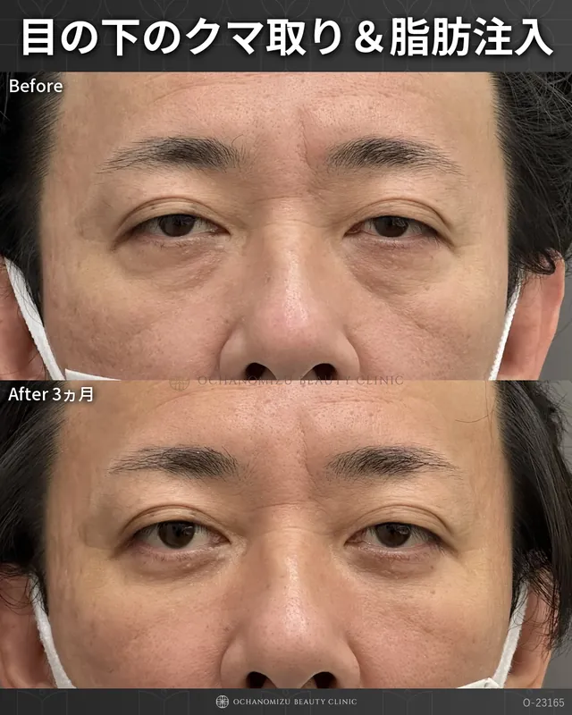 目の下のクマ取り＆脂肪注入