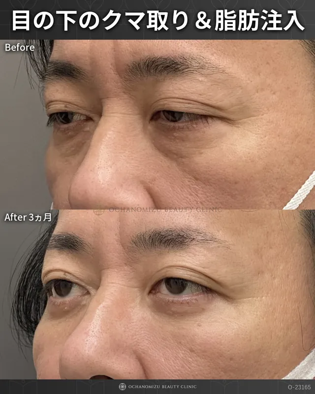 目の下のクマ取り＆脂肪注入