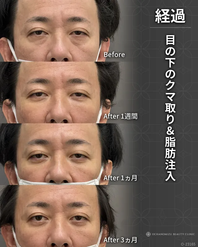 目の下のクマ取り＆脂肪注入