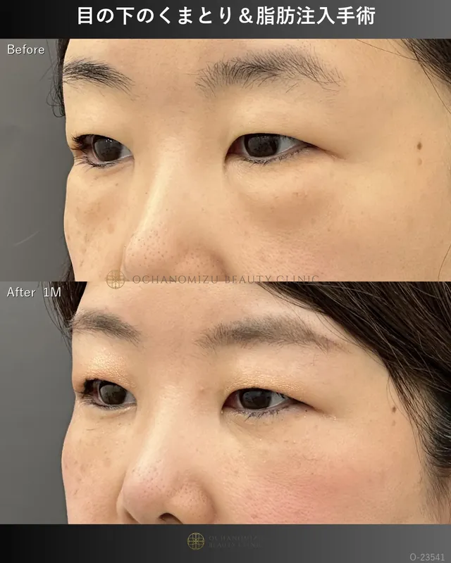 目の下のクマ取り・脂肪注入