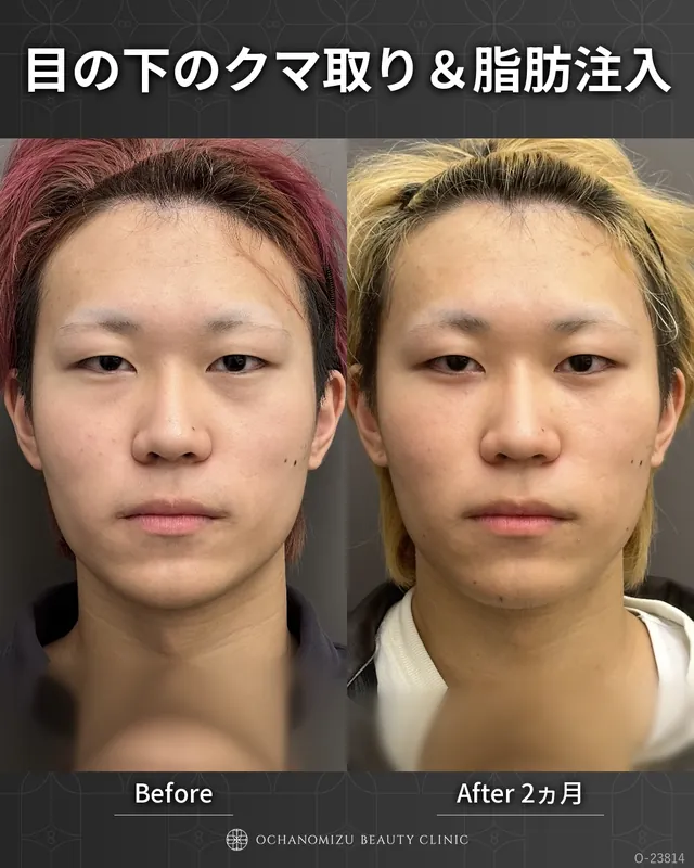 目の下のクマ取り＆脂肪注入