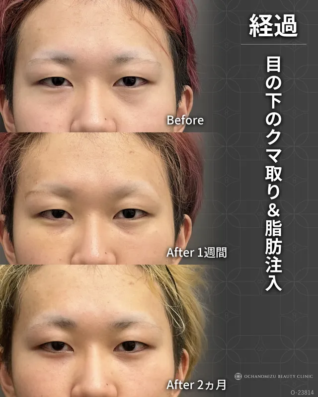 目の下のクマ取り＆脂肪注入