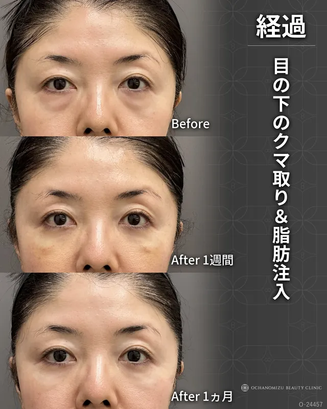 目の下のクマ取り＆脂肪注入