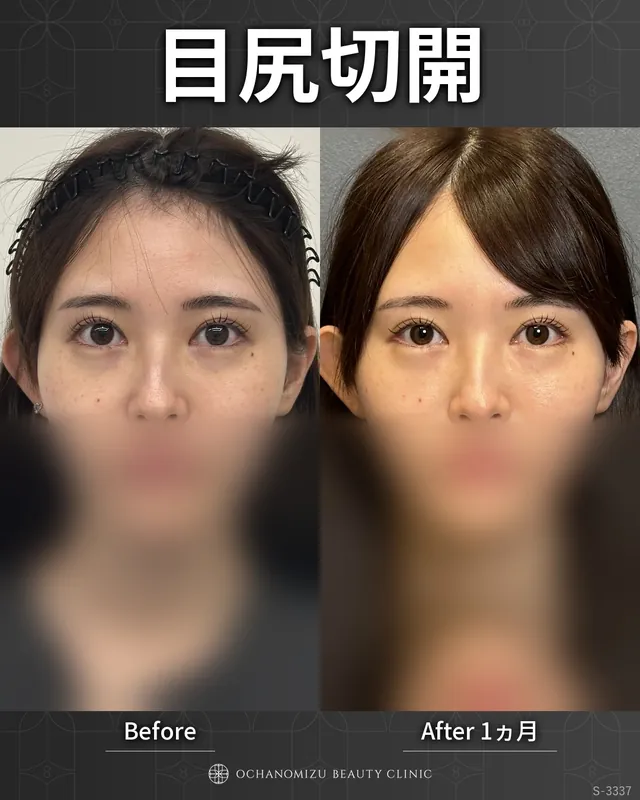目尻切開