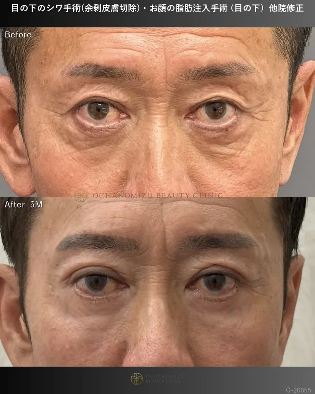目の下のシワ手術(余剰皮膚切除)＋顔の脂肪注入