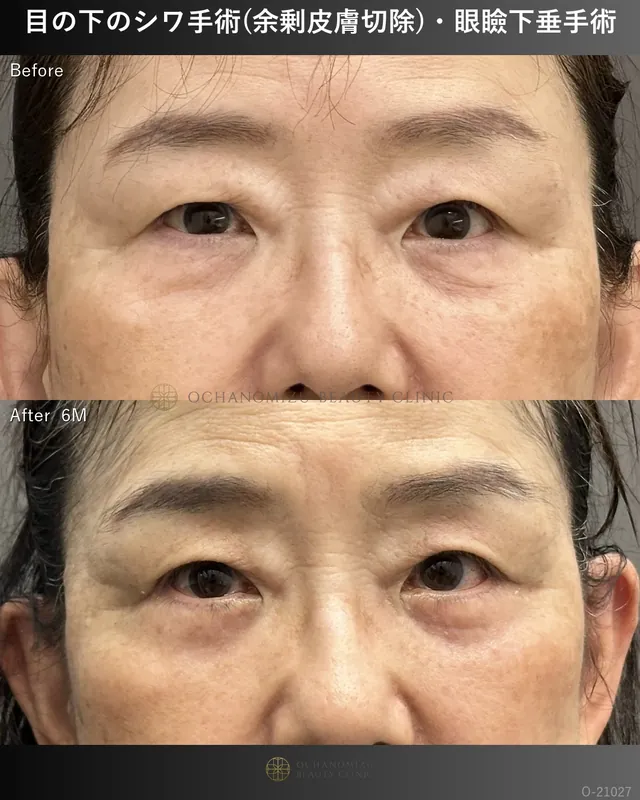 目の下のシワ手術(余剰皮膚切除)＋眼瞼下垂術
