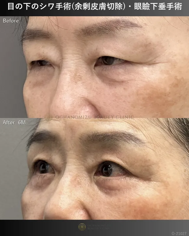 目の下のシワ手術(余剰皮膚切除)＋眼瞼下垂術