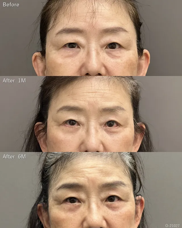 目の下のシワ手術(余剰皮膚切除)＋眼瞼下垂術