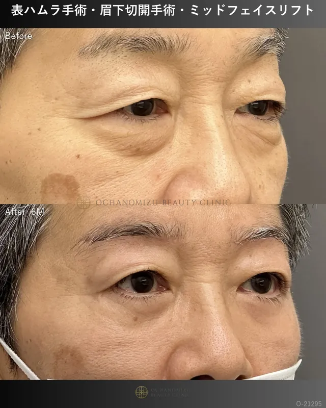 表ハムラ＋眉下切開＋ミッドフェイスリフト