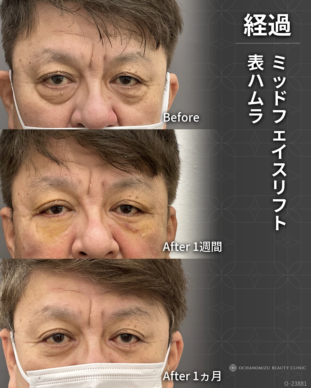 ミッドフェイスリフト＋表ハムラ