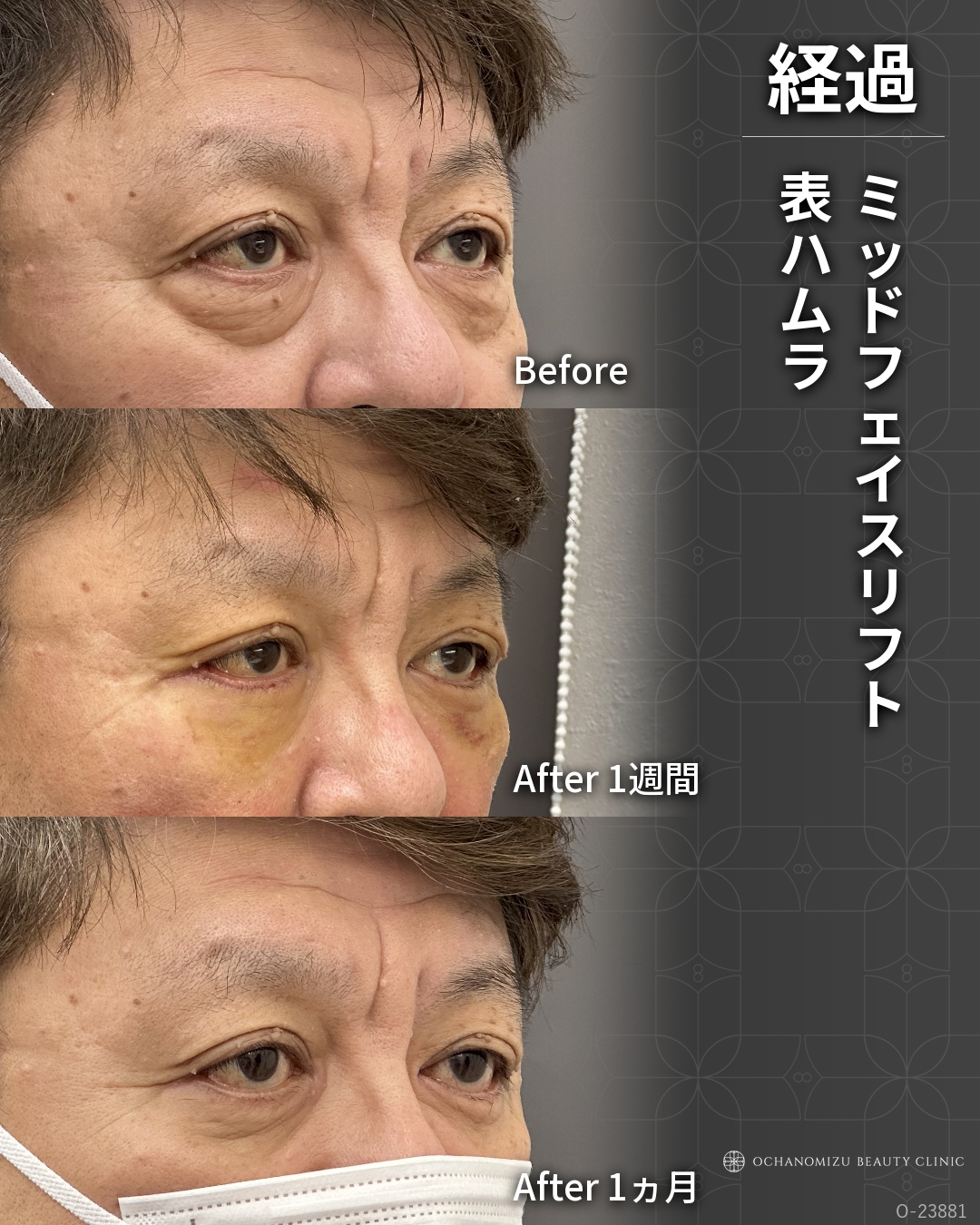 ミッドフェイスリフト＋表ハムラ