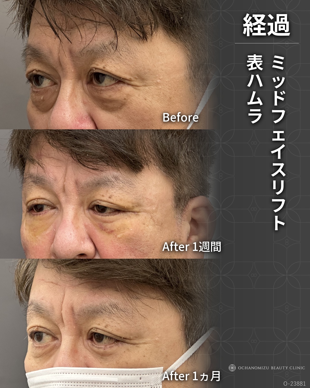 ミッドフェイスリフト＋表ハムラ