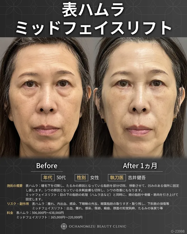 表ハムラ＋ミッドフェイスリフト