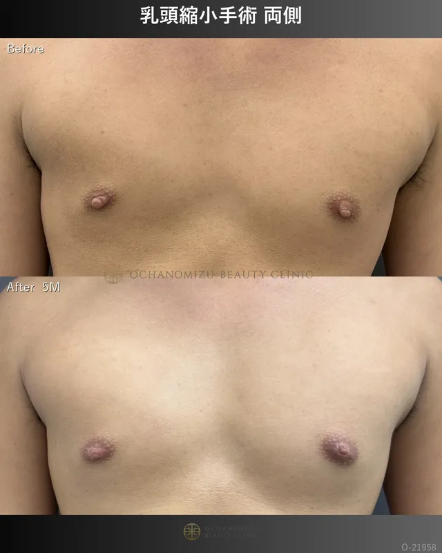 乳頭縮小
