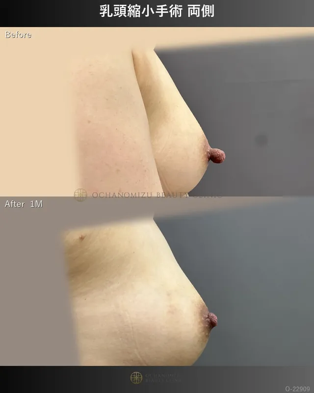乳頭縮小