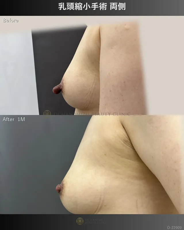 乳頭縮小