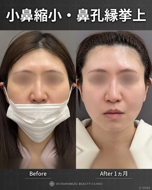 小鼻縮小＋鼻孔縁挙上