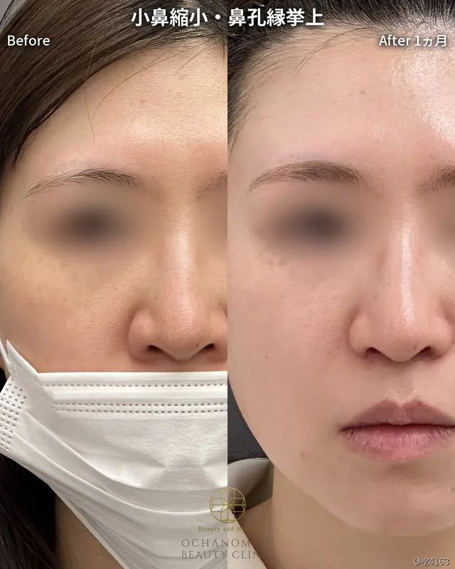 小鼻縮小＋鼻孔縁挙上