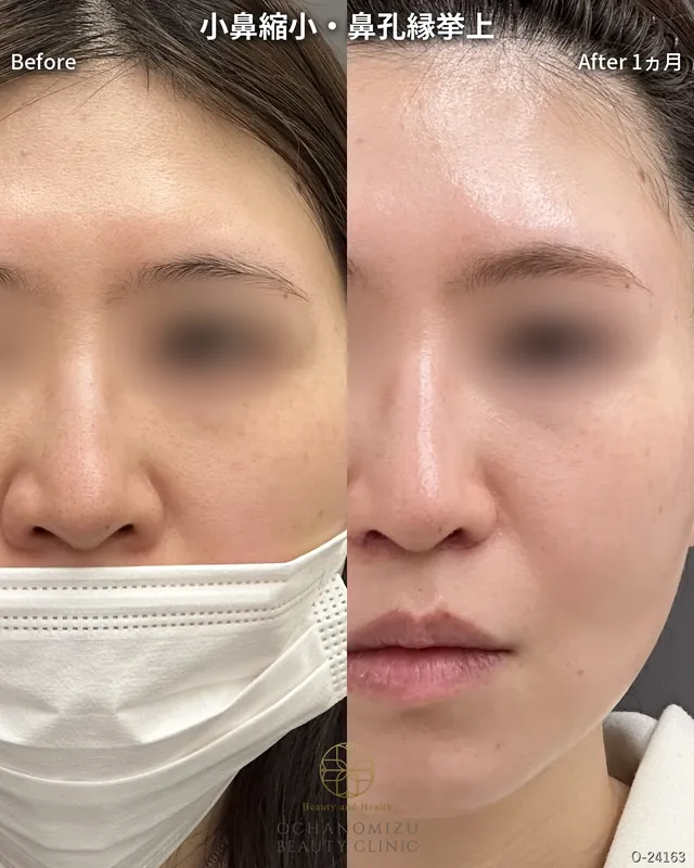 小鼻縮小＋鼻孔縁挙上