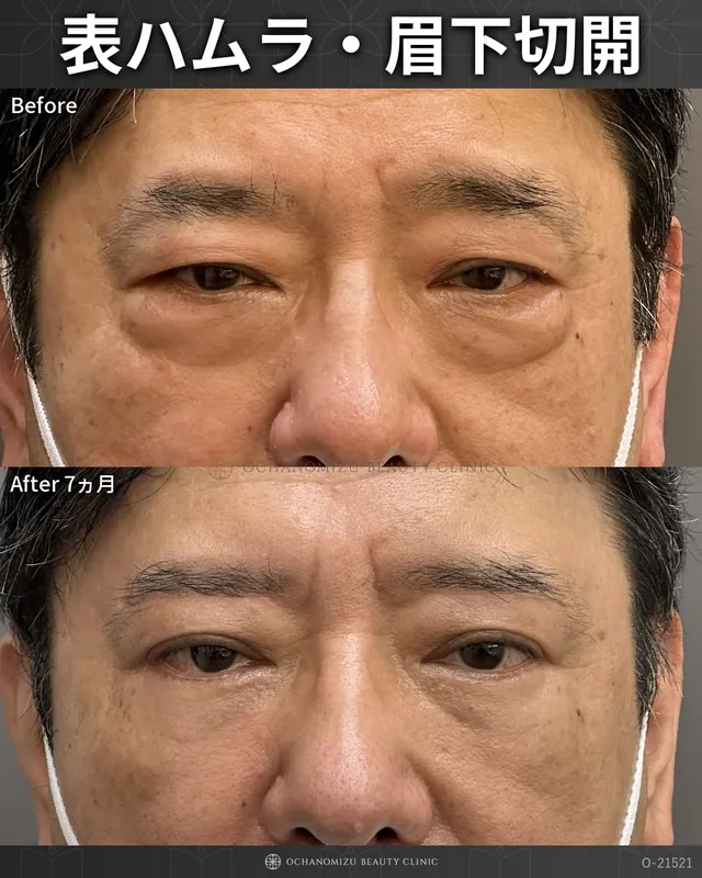 表ハムラ＋眉下切開