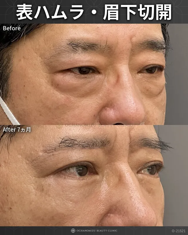 表ハムラ＋眉下切開