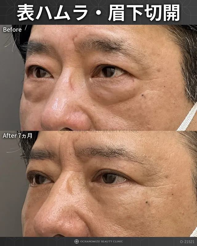 表ハムラ＋眉下切開