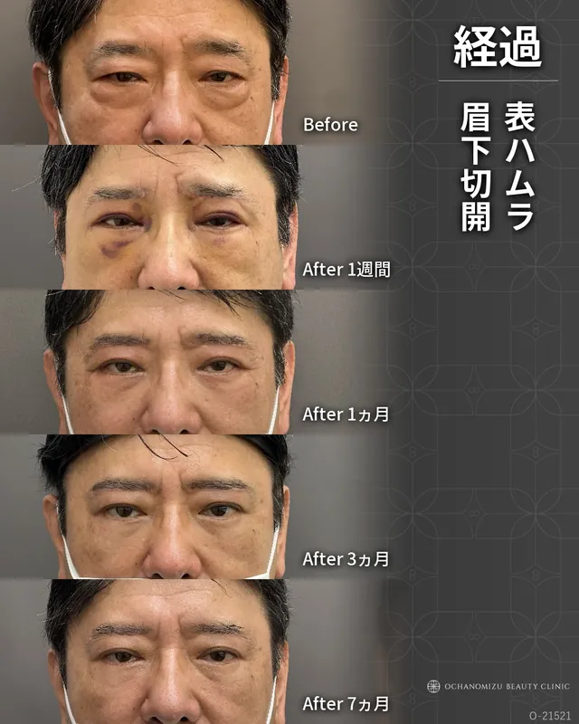 表ハムラ＋眉下切開